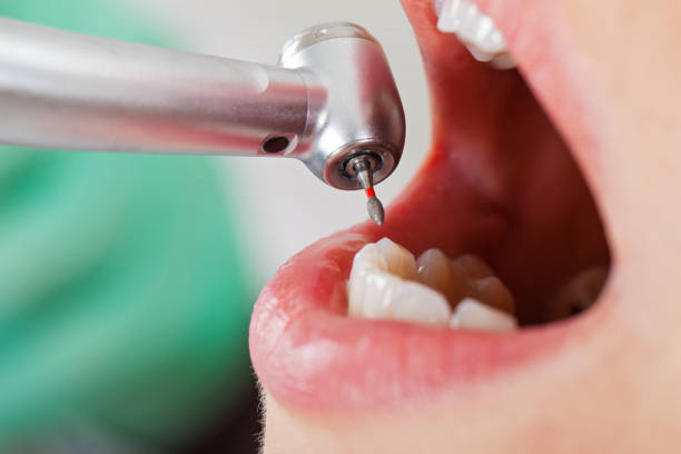 Best Emergency Treatment for Dental Infections or Abscesses in New Bremen, OH